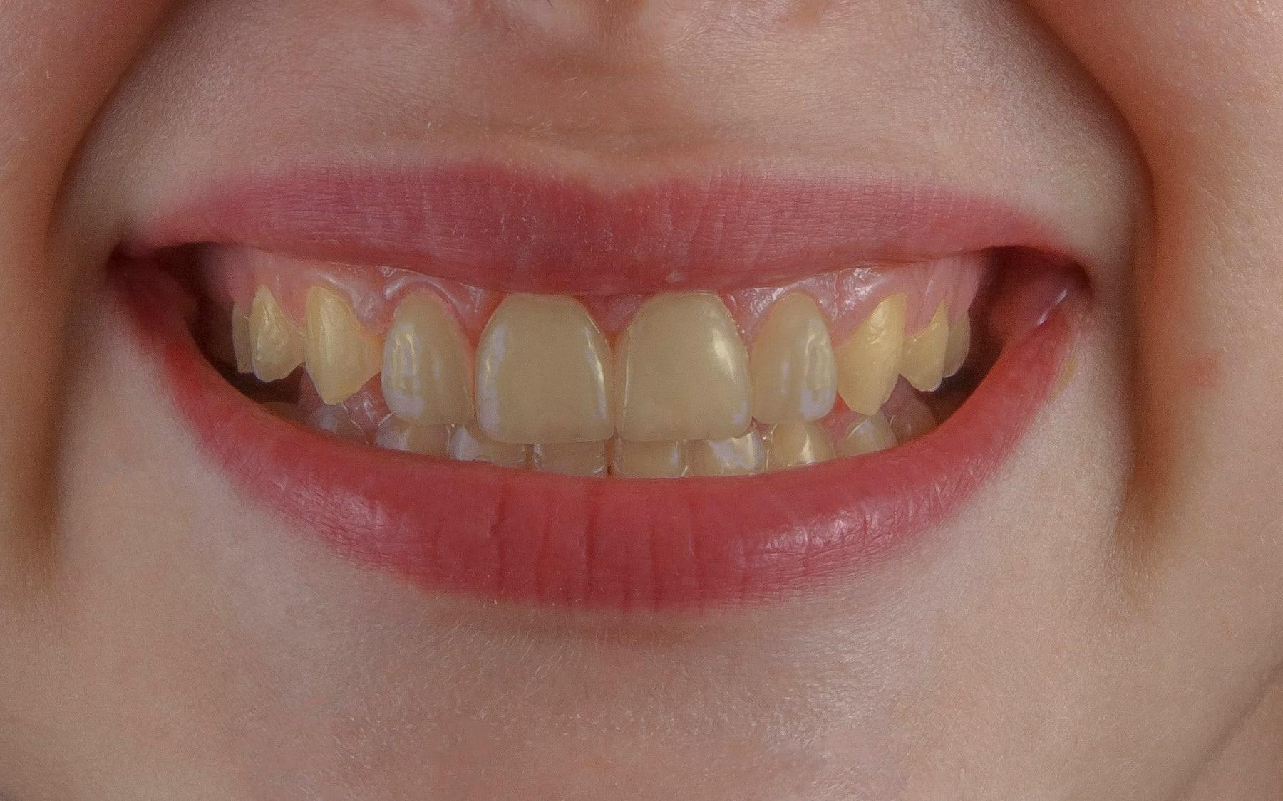 Sonrisa antes del blanqueamiento, con dientes amarillentos