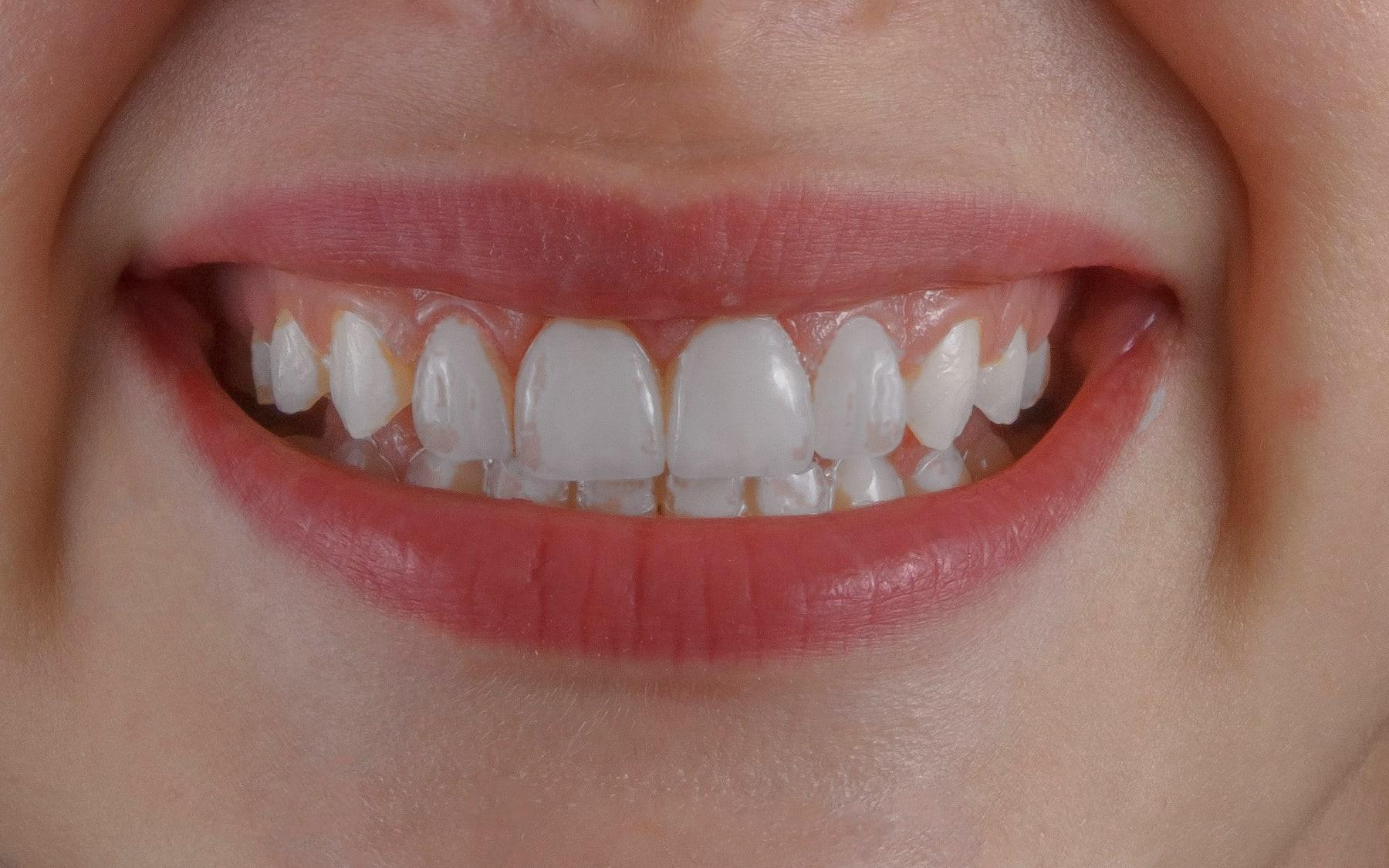 La misma sonrisa después del blanqueamiento, con dientes blancos